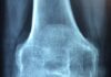 Osteoporoza – rodzaje, objawy, leczenie osteoporoza
