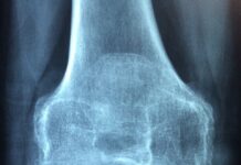 Osteoporoza – rodzaje, objawy, leczenie osteoporoza
