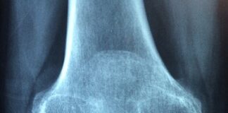 osteoporoza